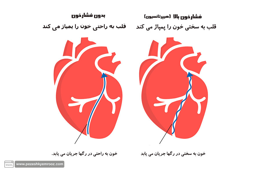 قلب| فشارخون| دخانیات| درمان| کلیه|نشانه های فشارخون بالا